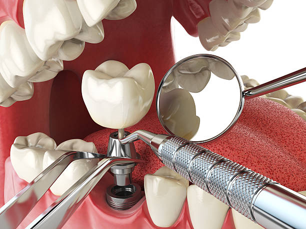 Best Emergency Wisdom Teeth Removal in La Marque, TX